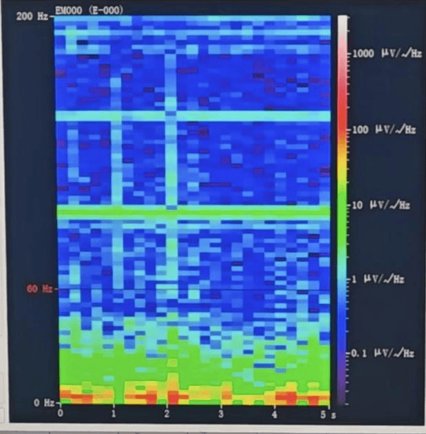 山西首例!山西省人民医院成功实施脑机接口辅助功能区脑肿瘤切除手术